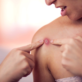 Фурункул – изображение №1 Фурункул – Заболевания, фото №1