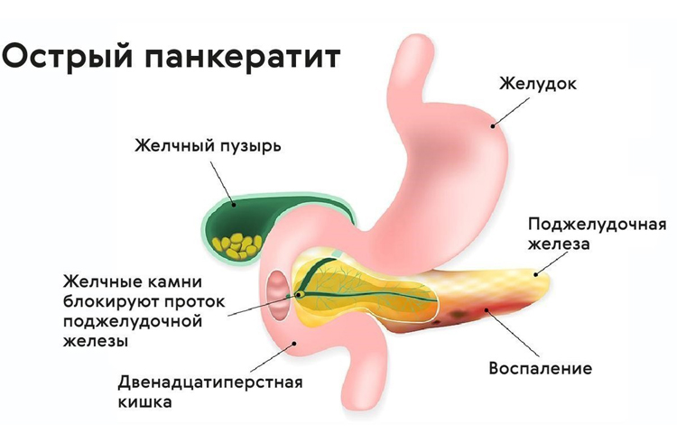 Панкреатит Фото Языка