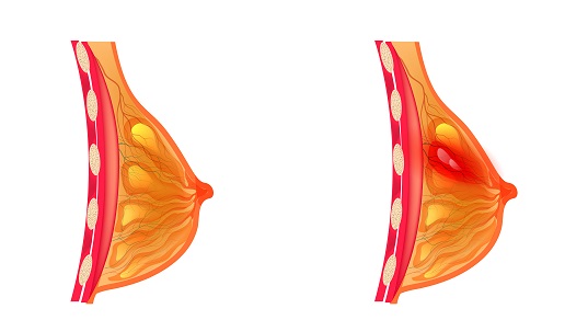 Отек молочных желез – изображение №2 Отек молочных желез – Симптомы, фото №2