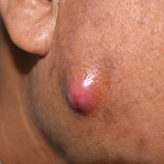 Абсцесс – изображение №1 Абсцесс – Заболевания, фото №1