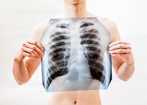 Рентген легких и грудной клетки – Анализы и диагностика, фото №1