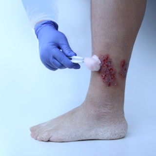 Трофическая язва – изображение №1 Трофическая язва – Заболевания, фото №1