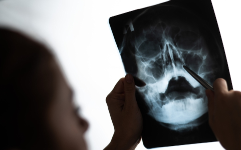 Рентген пазух носа – Анализы и диагностика, фото №2