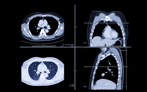 КТ грудной клетки – Анализы и диагностика, фото №2