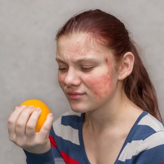 Пищевая аллергия – Заболевания, фото №1