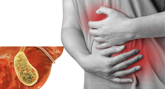 Холецистит