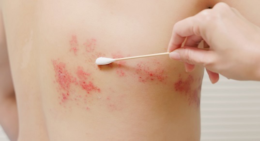 Вирус остается с нами навсегда